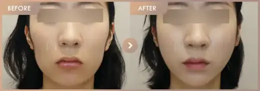 Thread lifting: before-and-after comparison at Newstar Clinic