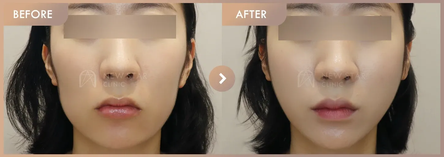 Thread lifting before-and-after photos at Newstar Clinic