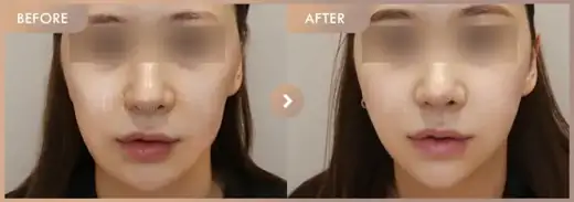 Thread lifting + ONDA lifting · 01: before-and-after comparison at Newstar Clinic
