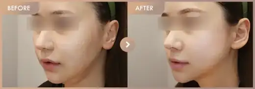 Thread lifting + ONDA lifting · 02: before-and-after comparison at Newstar Clinic