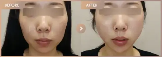 Thread lifting: before-and-after comparison at Newstar Clinic