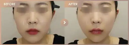Thread lifting: before-and-after comparison at Newstar Clinic