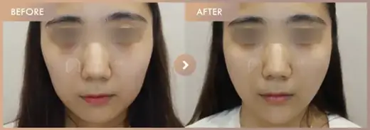 Thread lifting + Chin filler: before-and-after comparison at Newstar Clinic