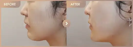 Thread lifting: before-and-after comparison at Newstar Clinic