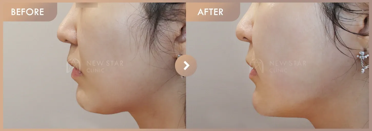 Thread lifting before-and-after photos at Newstar Clinic