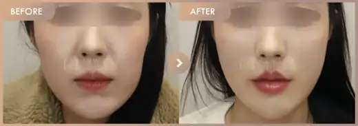 Thread lifting: before-and-after comparison at Newstar Clinic