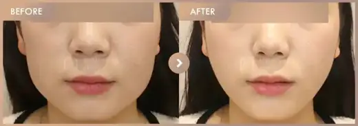 Thread lifting: before-and-after comparison at Newstar Clinic