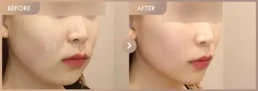 Thread lifting: before-and-after comparison at Newstar Clinic