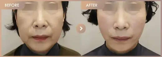 Thread lifting: before-and-after comparison at Newstar Clinic