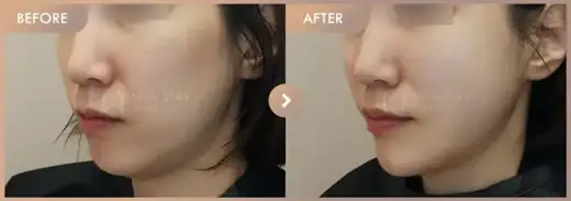 Thread lifting: before-and-after comparison at Newstar Clinic