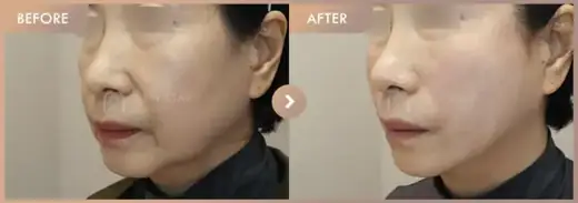 Thread lifting: before-and-after comparison at Newstar Clinic