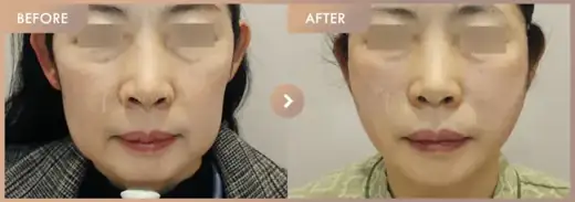 Thread lifting: before-and-after comparison at Newstar Clinic