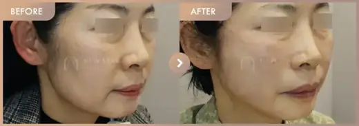 Thread lifting: before-and-after comparison at Newstar Clinic