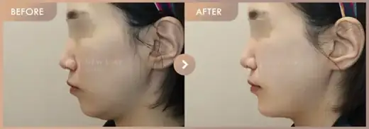 Thread lifting: before-and-after comparison at Newstar Clinic