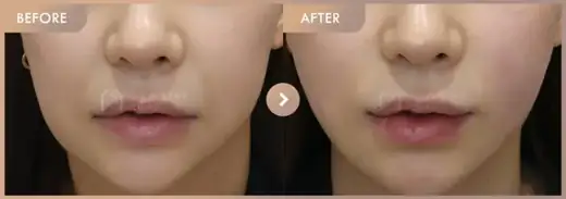 Thread lifting: before-and-after comparison at Newstar Clinic