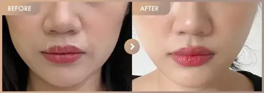Thread lifting: before-and-after comparison at Newstar Clinic