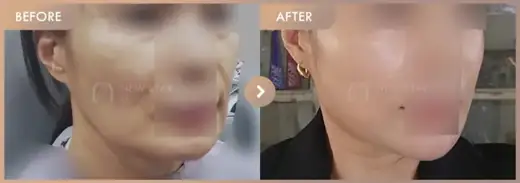 Thread lifting: before-and-after comparison at Newstar Clinic