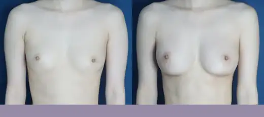 Sebbin breast augmentation at Re nu Plastic Surgery. Before and after