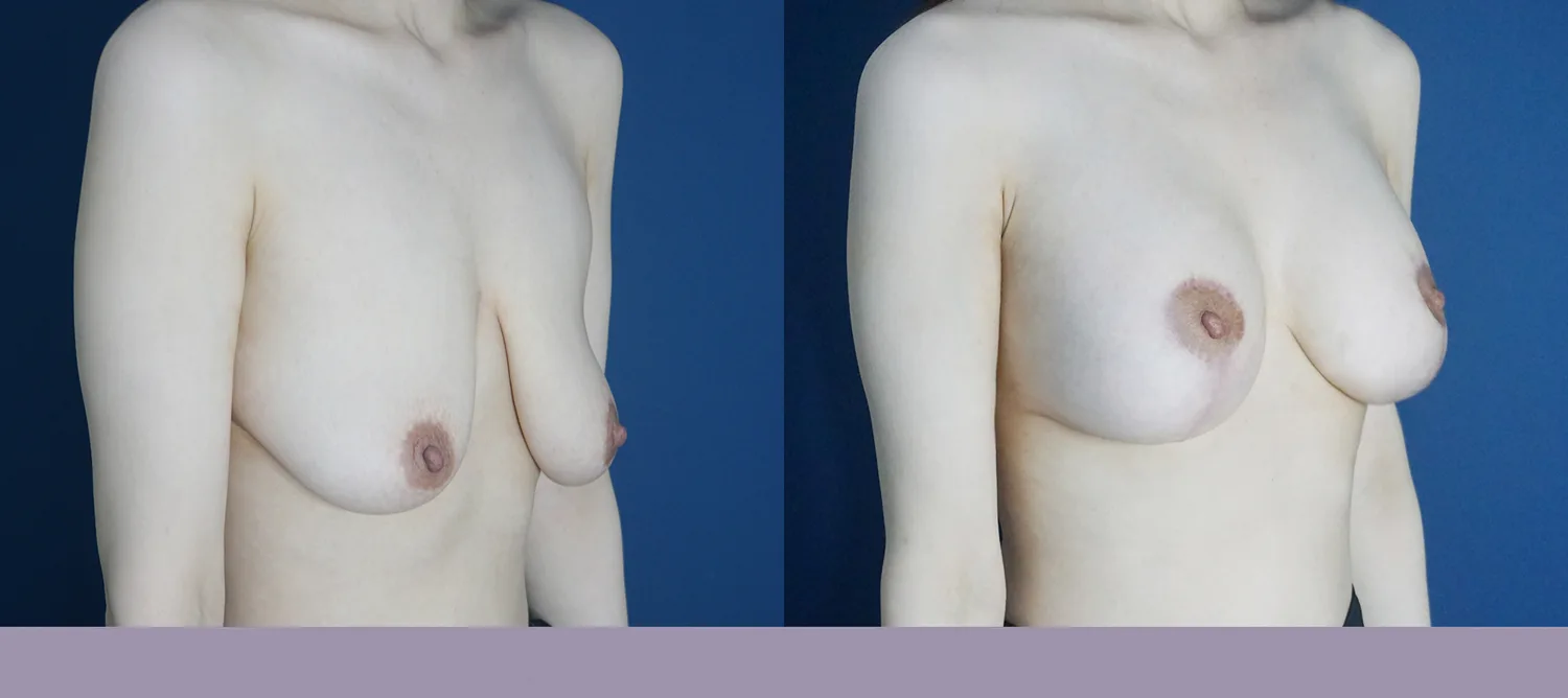 Breast augmentation with a vertical lift at Re nu Plastic Surgery. Oblique view