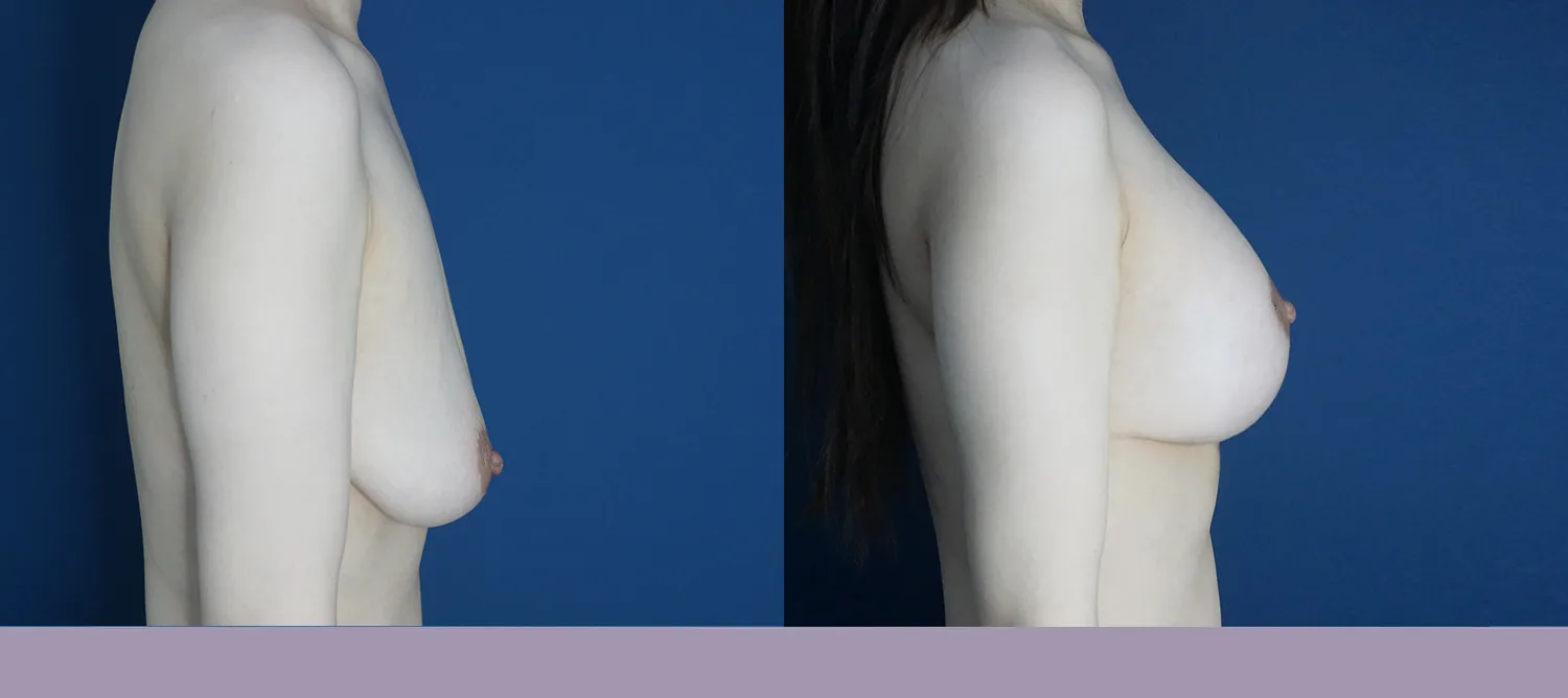 Breast augmentation with a vertical lift at Re nu Plastic Surgery. Side view