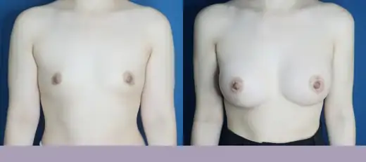 Motiva breast augmentation at Re nu Plastic Surgery. Before and after