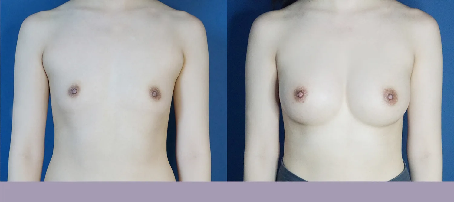 Mentor breast augmentation at Re nu Plastic Surgery. Before and after
