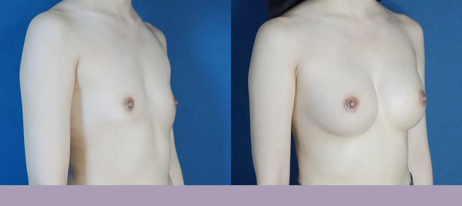 Mentor breast augmentation at Re nu Plastic Surgery. Oblique view