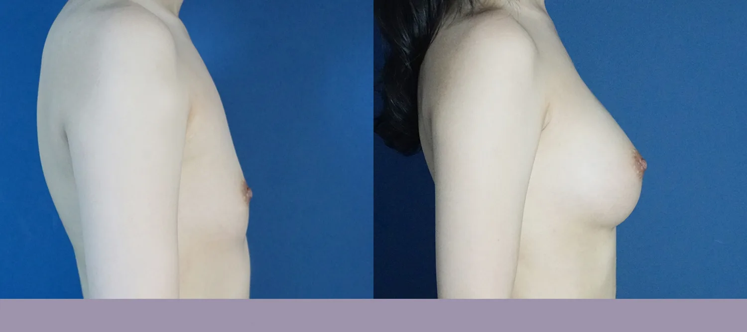 Mentor breast augmentation at Re nu Plastic Surgery. Side view