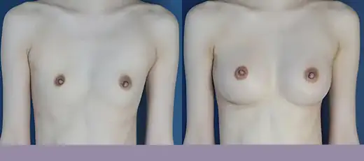 Breast augmentation for asymmetry at Re nu Plastic Surgery. Before and after