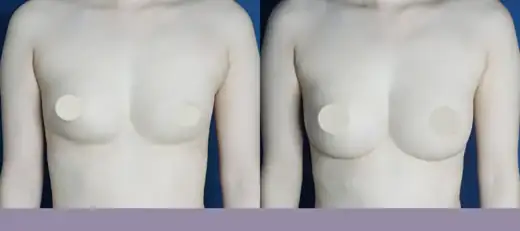Breast filler removal and implants at Re nu Plastic Surgery. Before and after