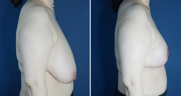 Large-volume breast reduction at Re nu Plastic Surgery. Side view