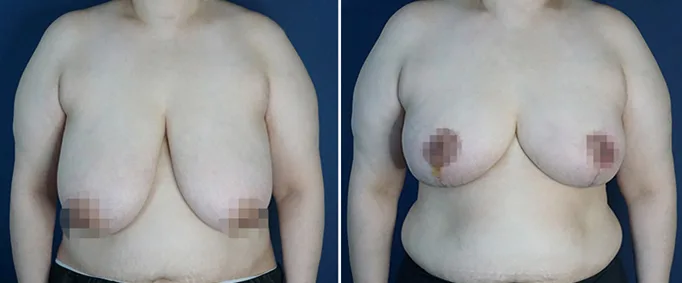 Large-volume breast reduction at Re nu Plastic Surgery. Before and after