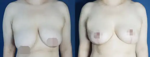 Anchor-incision breast reduction at Re nu Plastic Surgery. Before and after