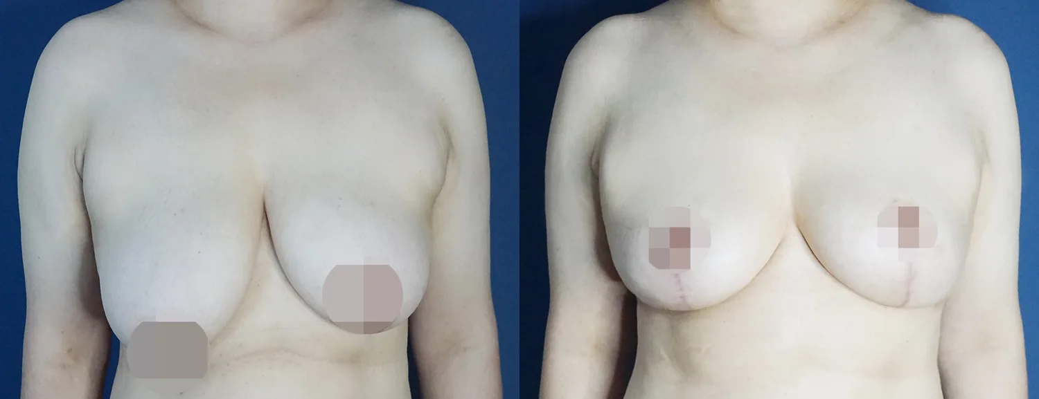 Anchor-incision breast reduction at Re nu Plastic Surgery. Before and after