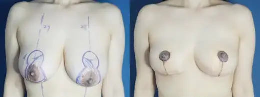 Vertical-incision breast reduction at Re nu Plastic Surgery. Front view