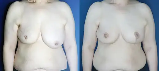 Breast correction with different techniques on each side at Re nu Plastic Surgery. Before and after