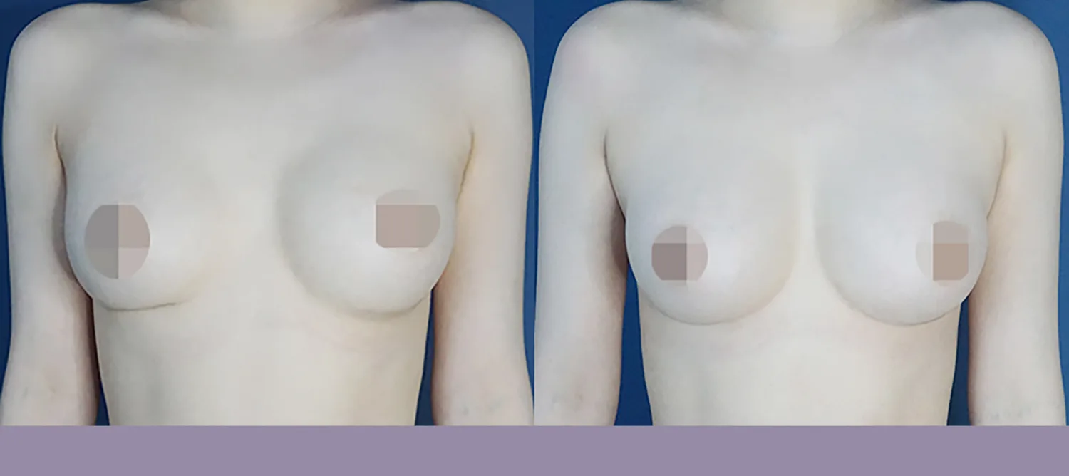Breast revision for capsular contracture and lateral implant displacement at Re nu Plastic Surgery. Before and after