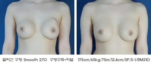 Breast revision for capsular contracture and implant rupture at Re nu Plastic Surgery. Before and after