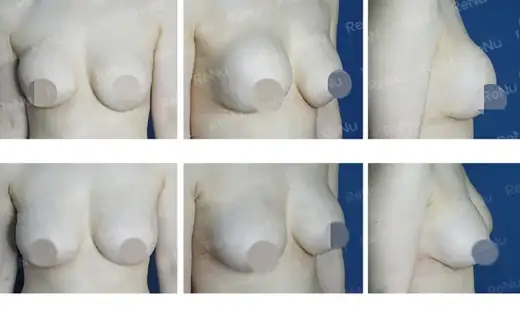 Breast revision for capsular contracture and size dissatisfaction at Re nu Plastic Surgery. Before and after