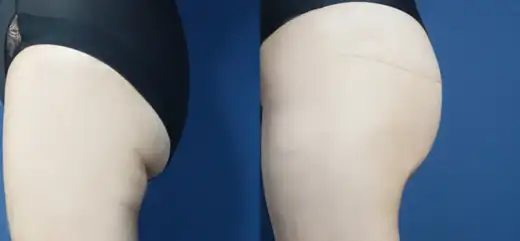 Buttock lift at Re nu Plastic Surgery. Before and after