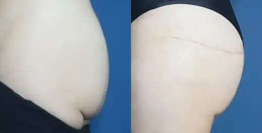 Buttock lift at Re nu Plastic Surgery. Before and after