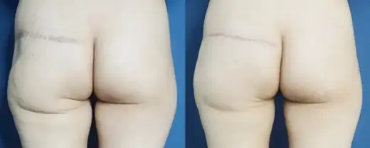 Buttock lift revision at Re nu Plastic Surgery. Before and after