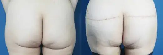 Buttock lift at Re nu Plastic Surgery. Before and after