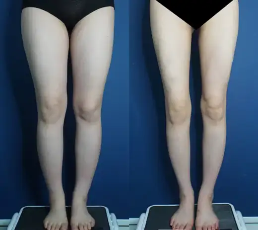 Thigh and calf liposuction at Re nu Plastic Surgery. Front view