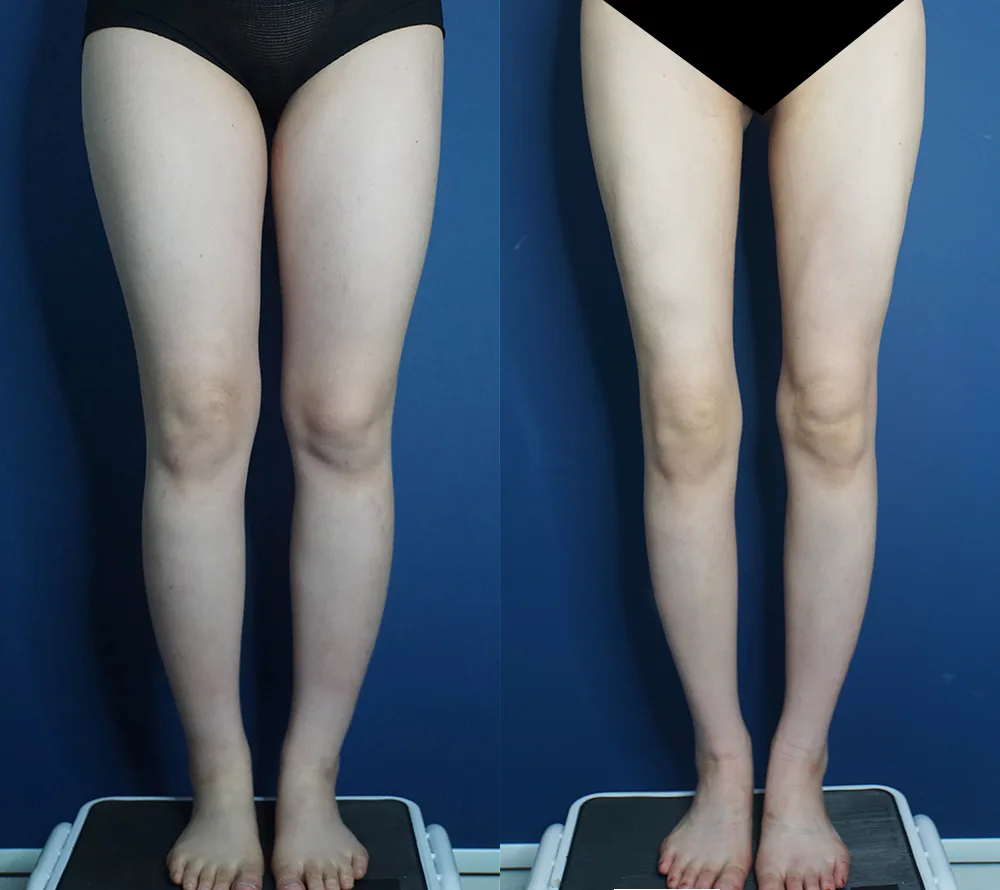 Thigh and calf liposuction at Re nu Plastic Surgery. Front view