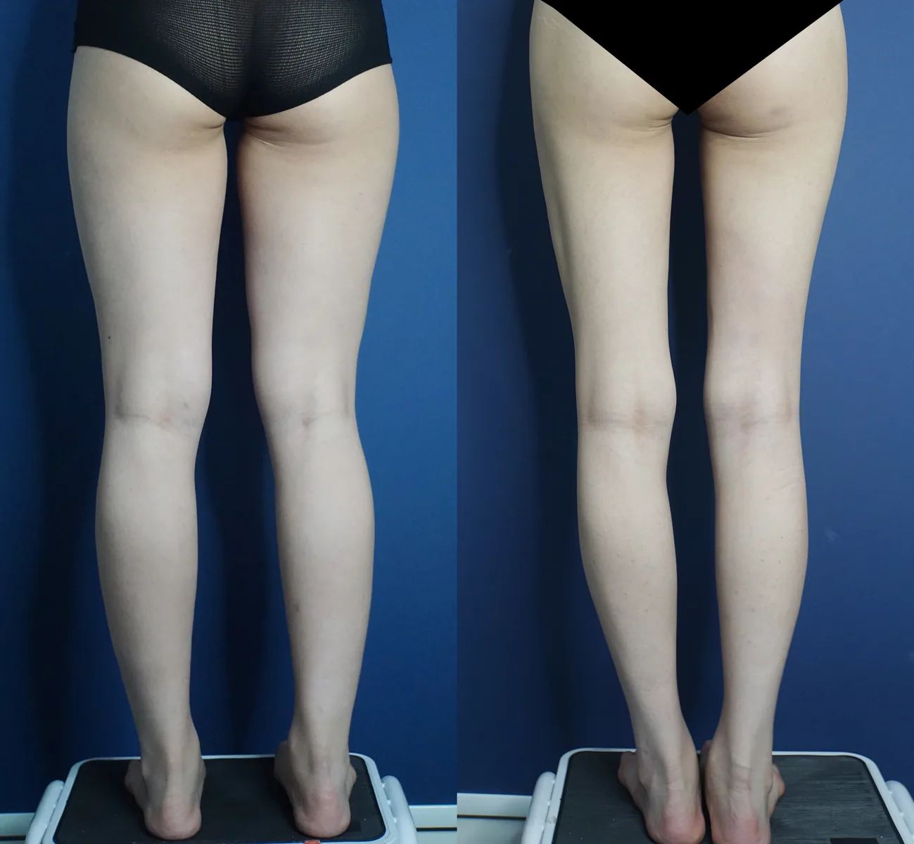 Thigh and calf liposuction at Re nu Plastic Surgery. Back view