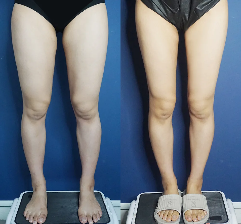 Thigh and calf liposuction at Re nu Plastic Surgery. Front view