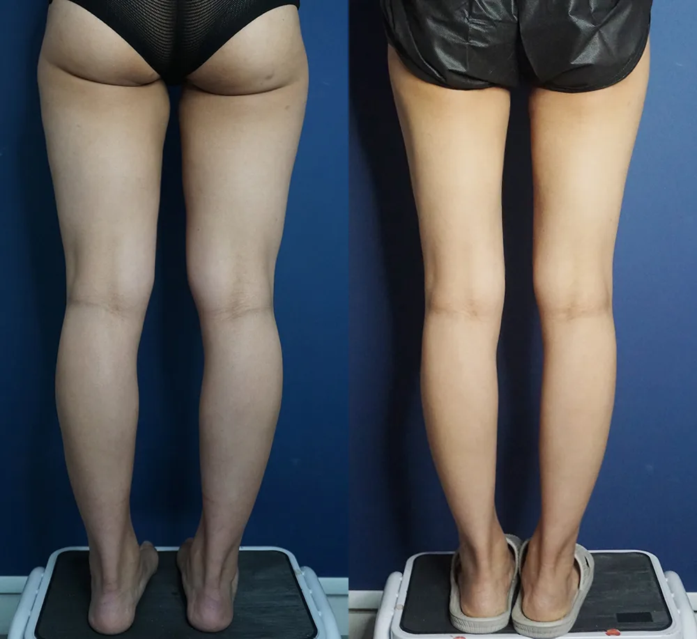 Thigh and calf liposuction at Re nu Plastic Surgery. Back view