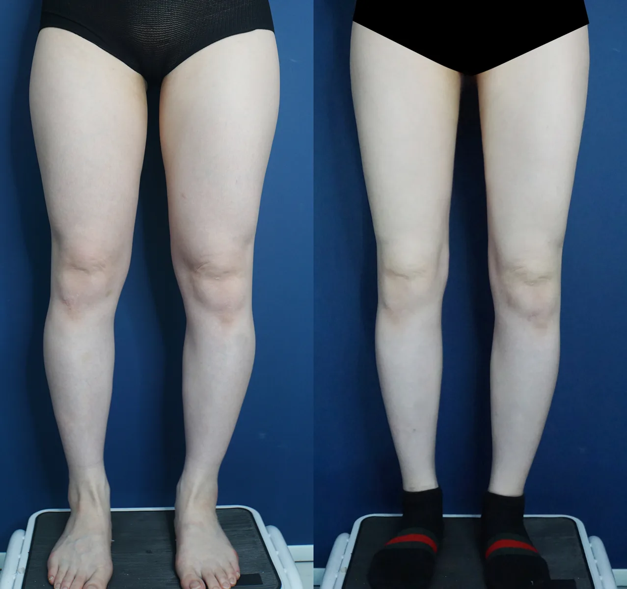 Thigh and calf liposuction at Re nu Plastic Surgery. Front view