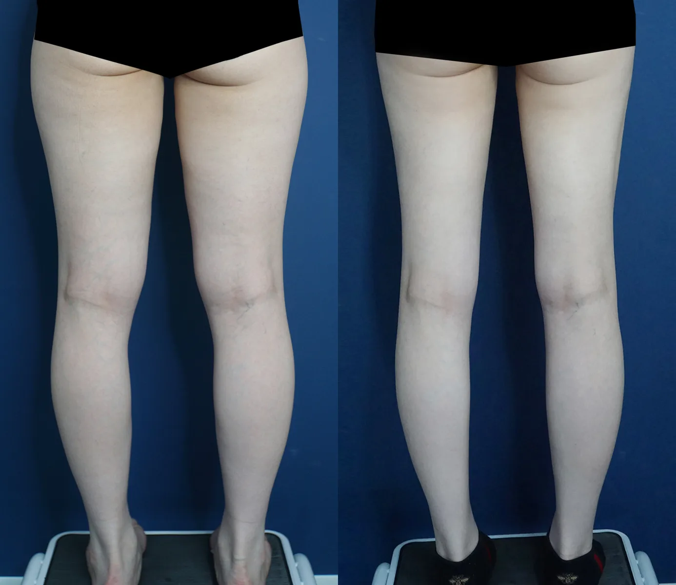 Thigh and calf liposuction at Re nu Plastic Surgery. Back view